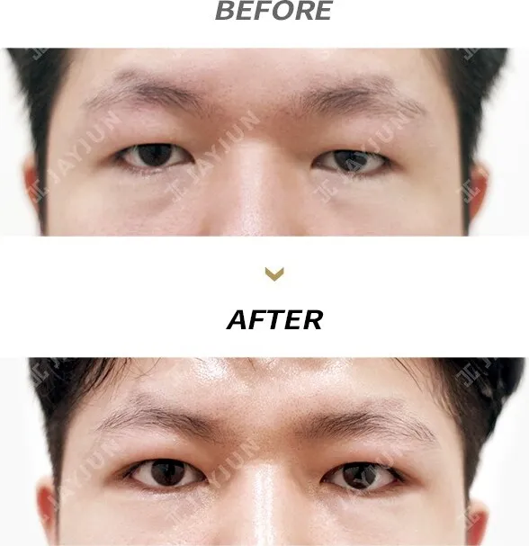 Before/After