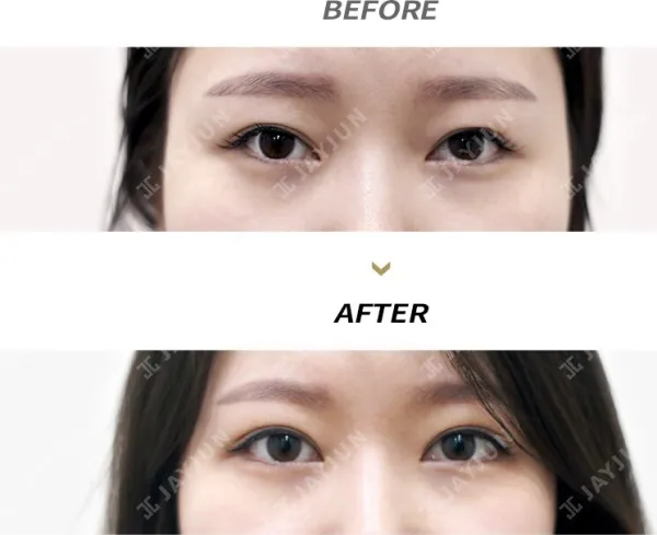 Before/After