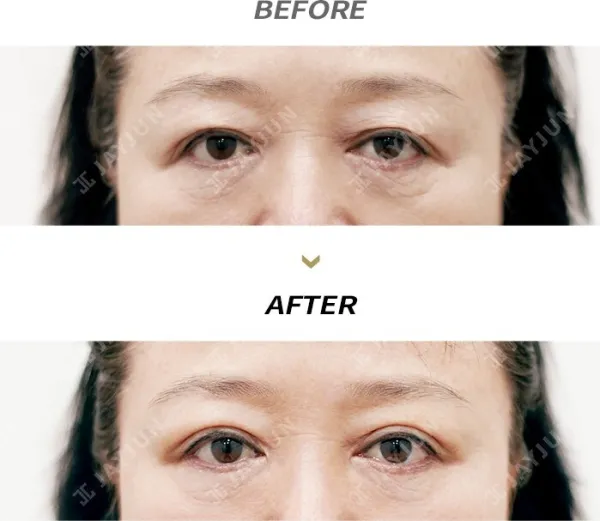 Before/After