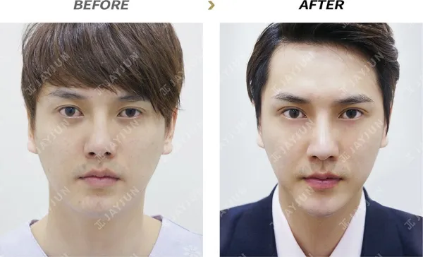 Before/After