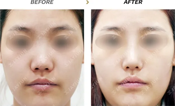 Before/After