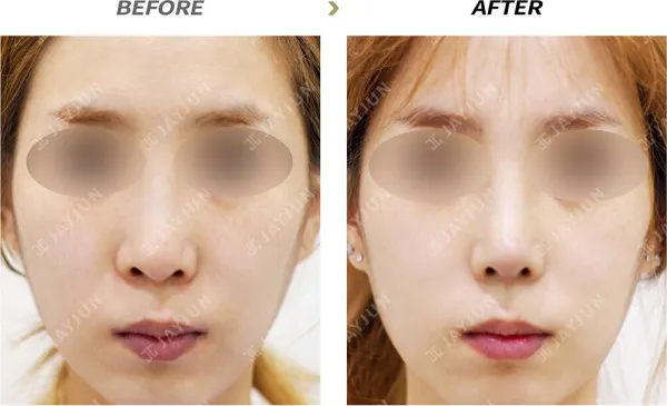 Before/After