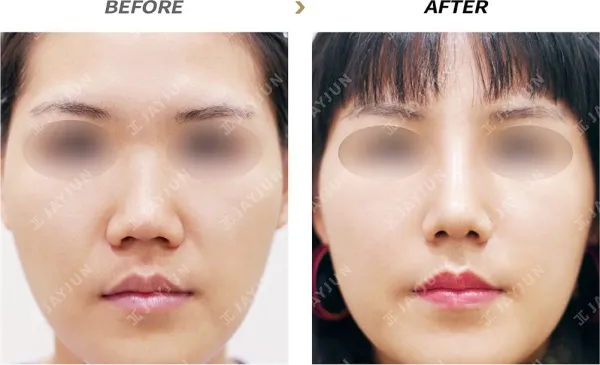 Before/After