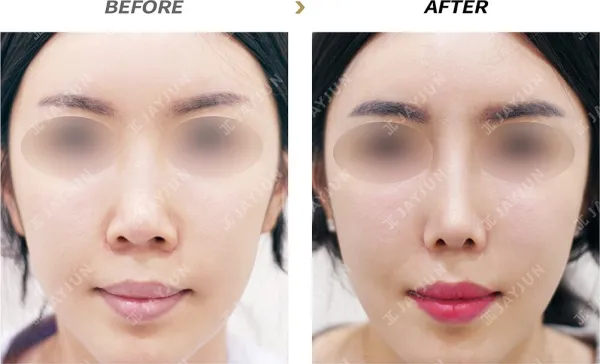 Before/After