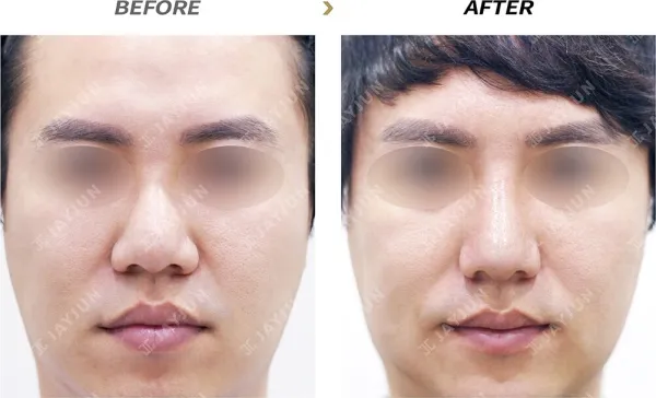 Before/After