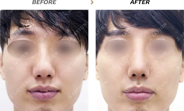 Before/After