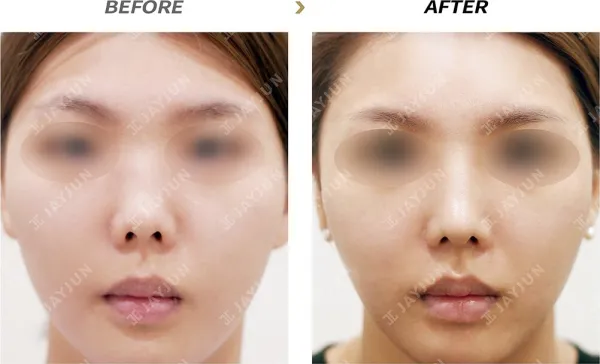 Before/After