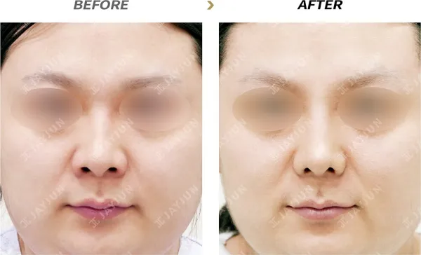 Before/After
