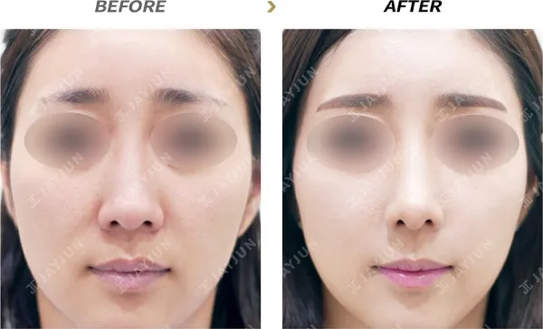 Before/After