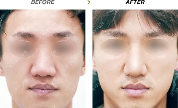 Before/After