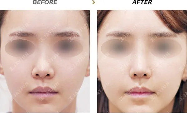 Before/After