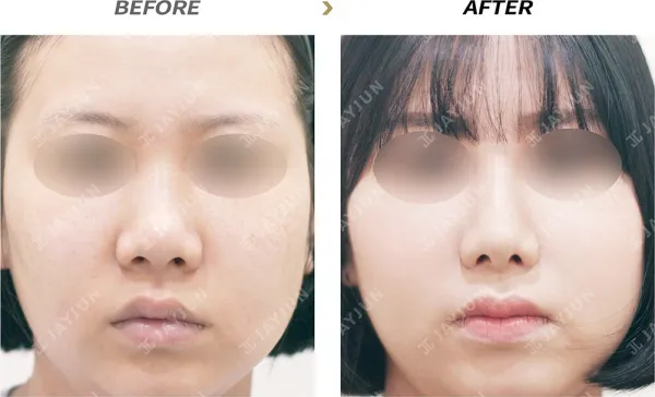 Before/After