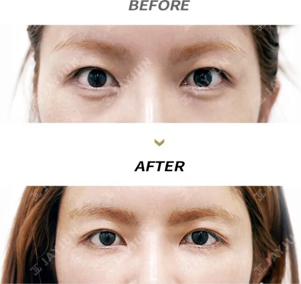 Before/After