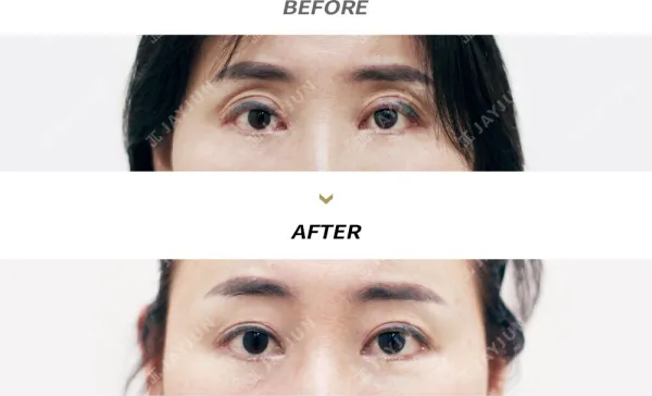 Before/After