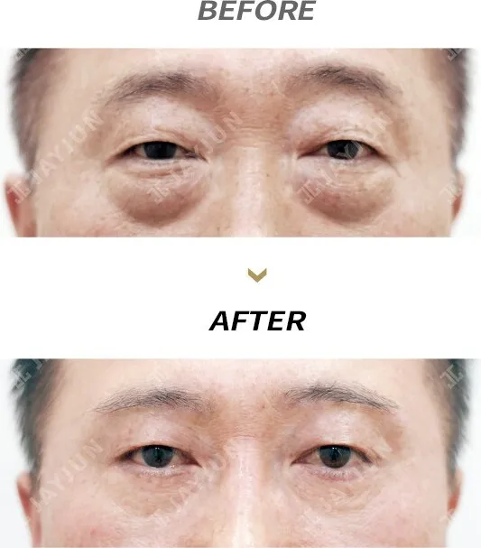 Before/After