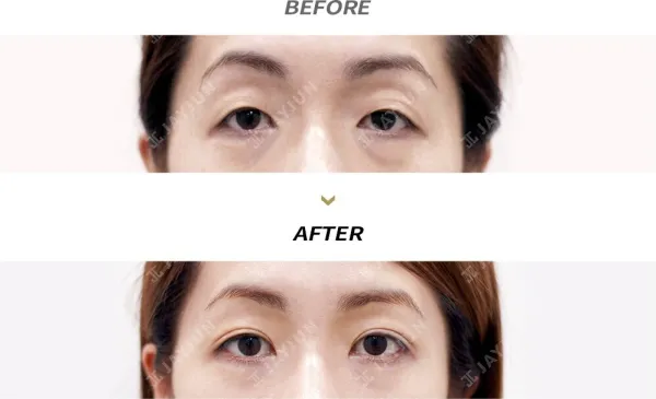 Before/After