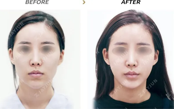 Before/After
