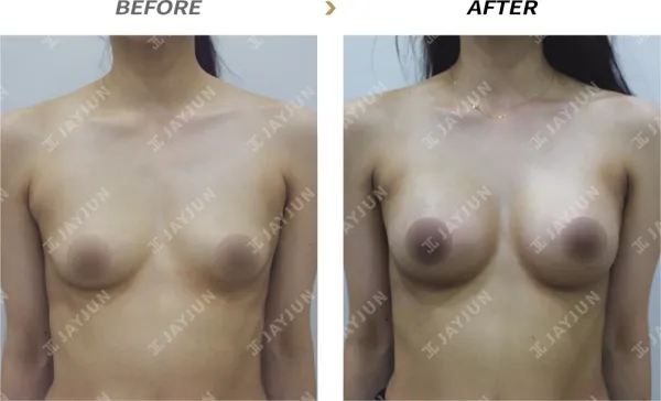 Before/After