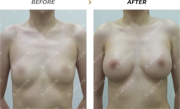 Before/After