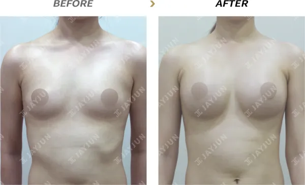 Before/After
