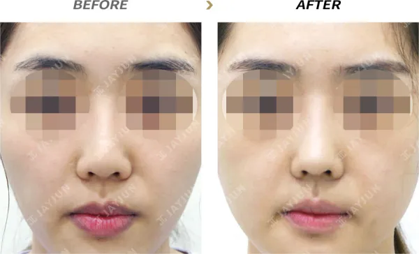 Before/After