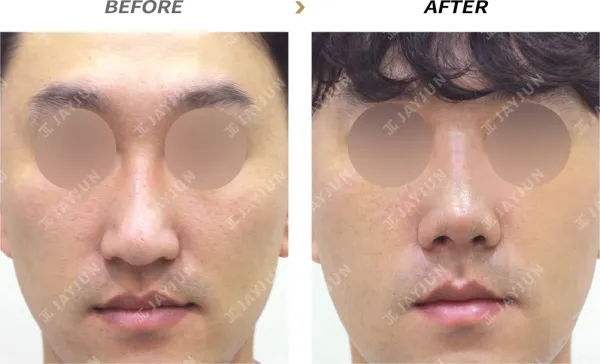 Before/After