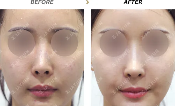 Before/After