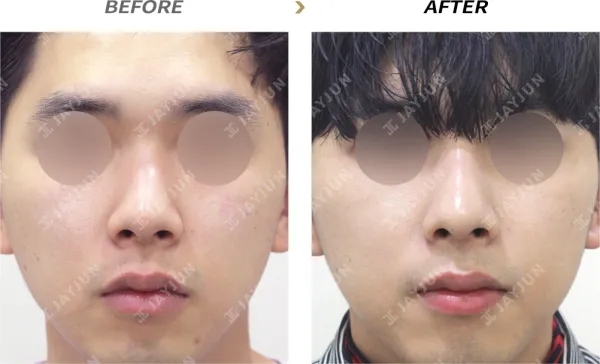 Before/After