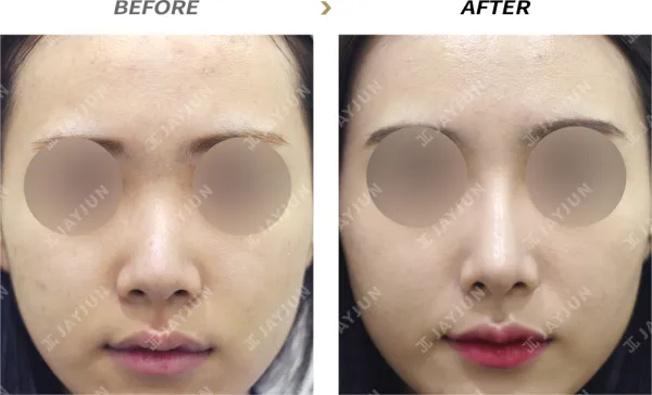 Before/After
