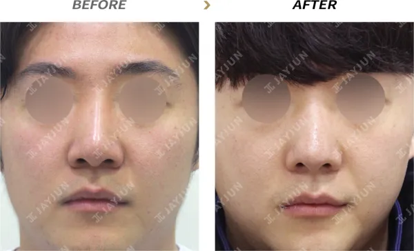 Before/After