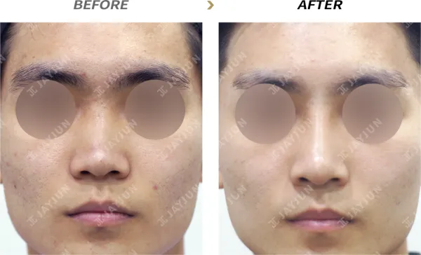 Before/After