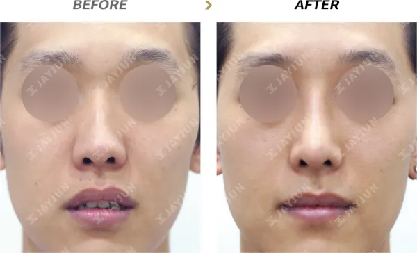 Before/After