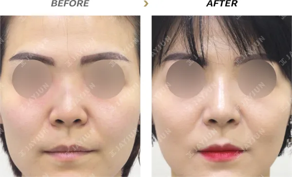 Before/After