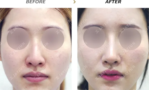 Before/After