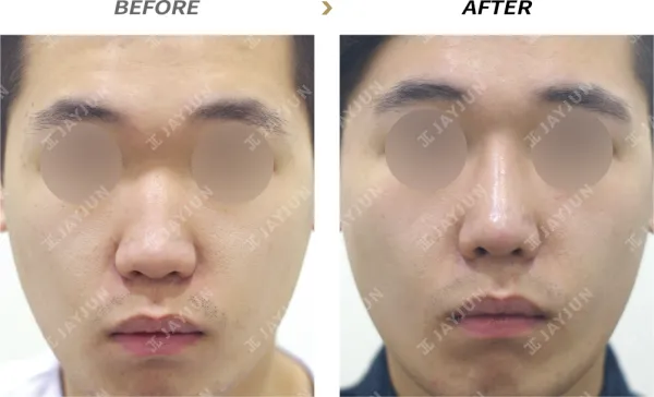 Before/After