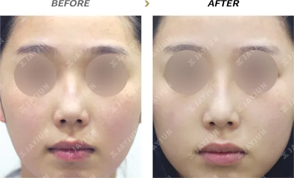 Before/After