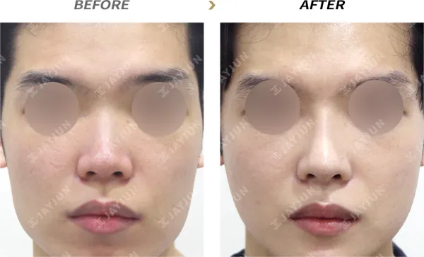 Before/After