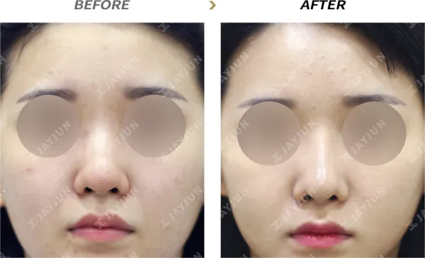 Before/After