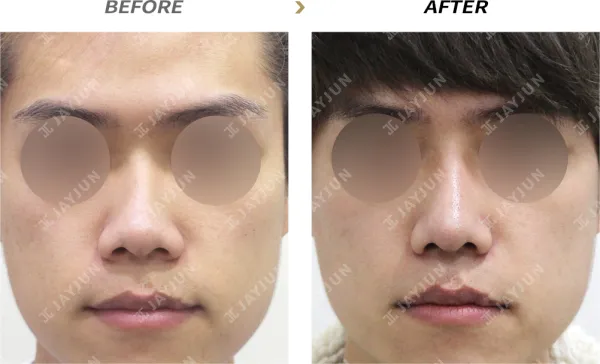 Before/After