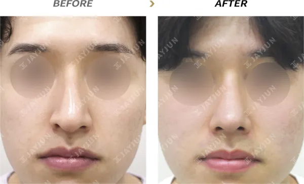 Before/After