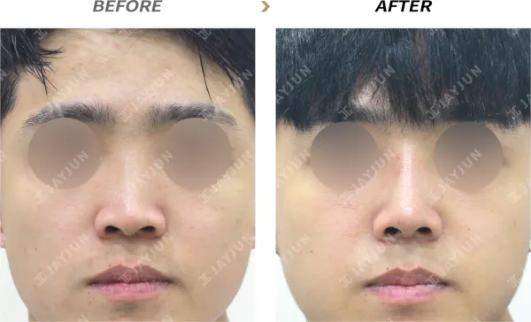 Before/After