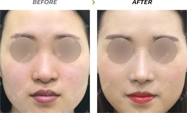 Before/After