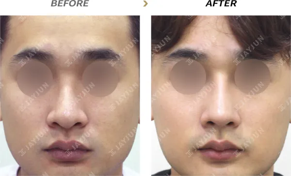 Before/After