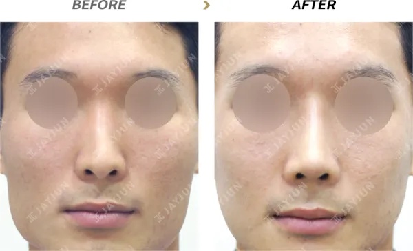 Before/After