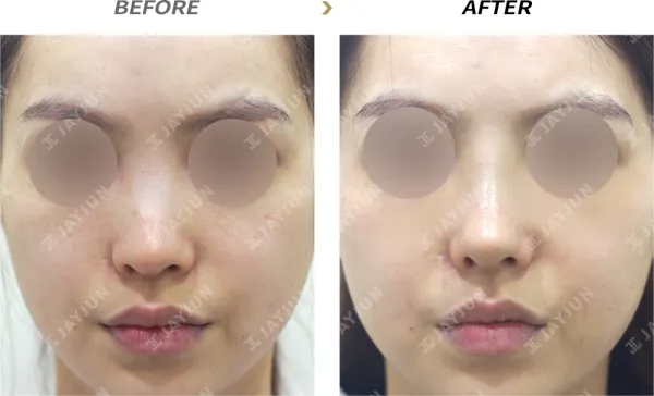 Before/After