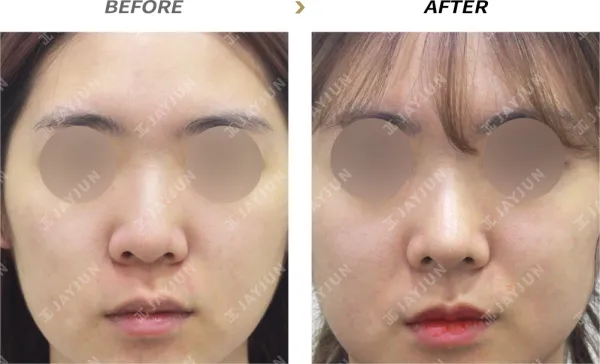 Before/After
