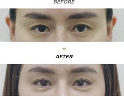 Before & After