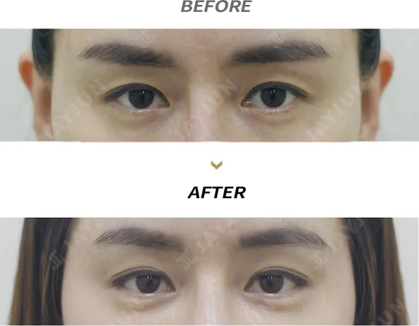 Before/After