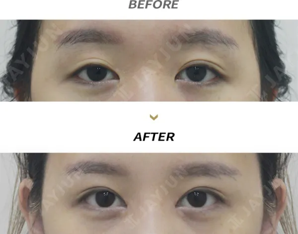 Before/After