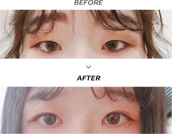 Before/After